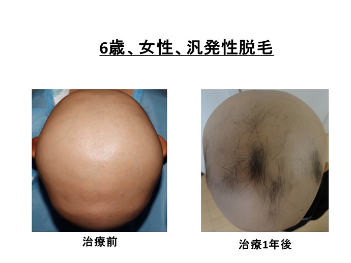 円形脱毛症　病院